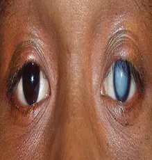 kōkṅ kaṇṇu